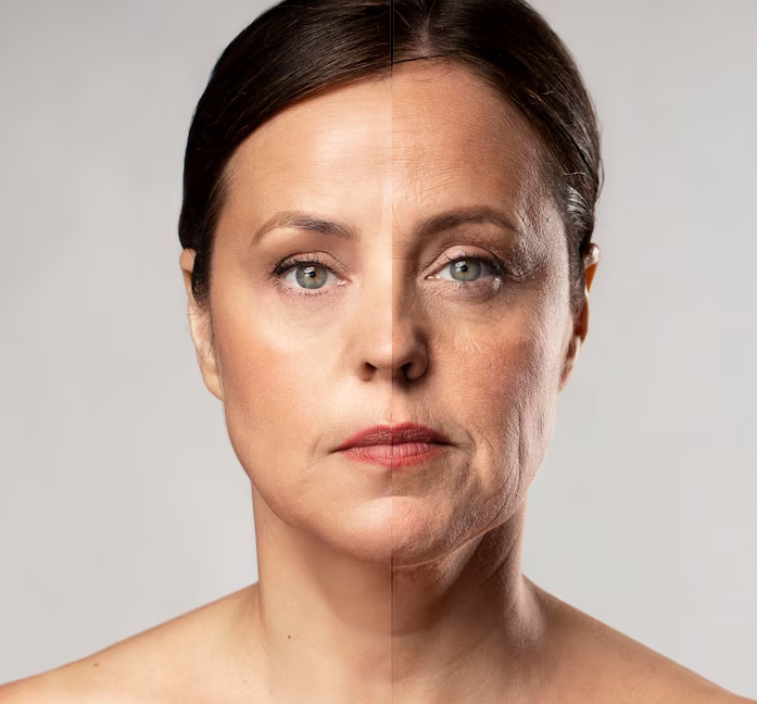 BBL Skin Rejuvenation